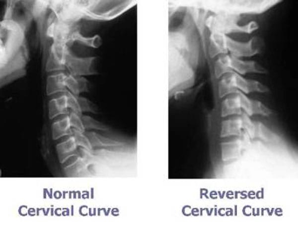 Two X-rays of the cervical spine shown side-by-side comparing a normal cervical curve with a reversed cervical curve.