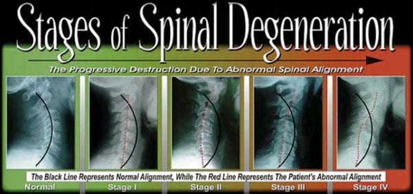Stages-of-Spinal-Degeneration