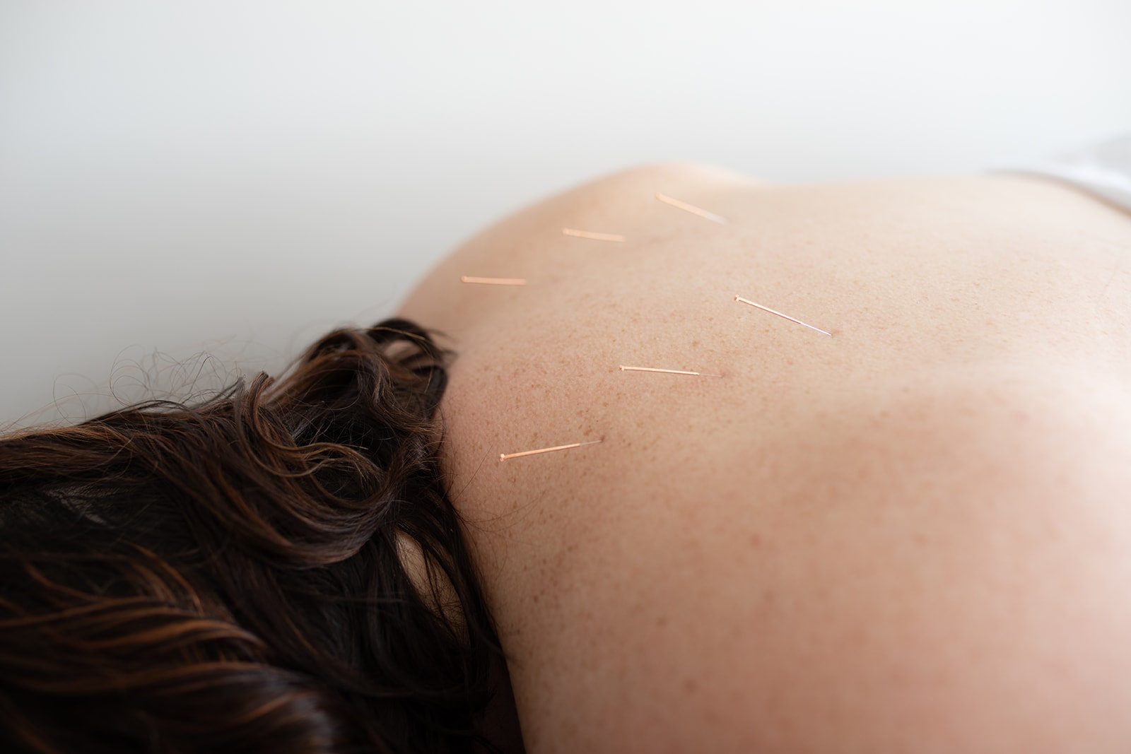 Close-up of acupuncture needles in a patient's back during treatment